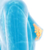 早期浸潤性乳がん、2次がんのリスクは？／BMJ
