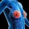 転移乳がんへのCDK4/6阻害薬＋内分泌療法の効果、HER2ゼロと低発現で解析（PALOMA-2、PALOMA-3）