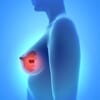CDK4/6阻害薬治療中に進行したHR+HER2-転移乳がん、生存に関連する因子は？