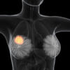 転移乳がんへのT-DXd後治療、アウトカムを比較